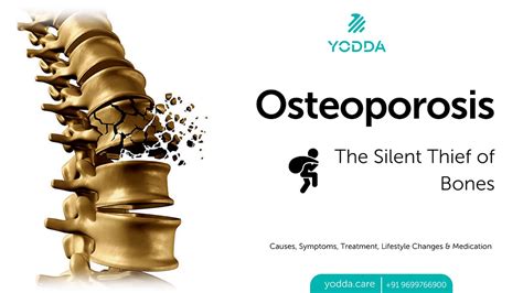  Osteoporosis: A Silent Thief Stealing Your Bones!